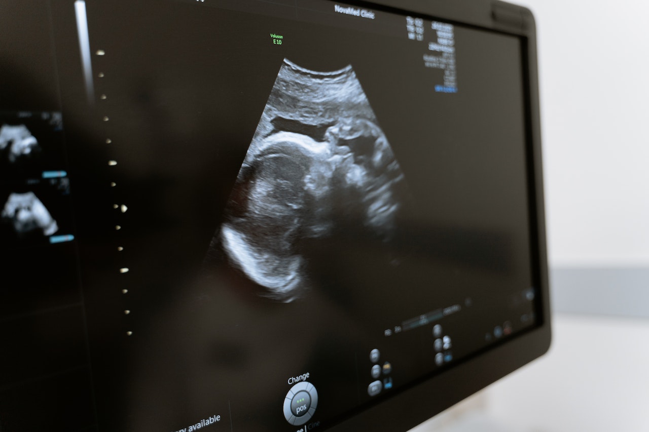 Pregnancy Pelvic Scan